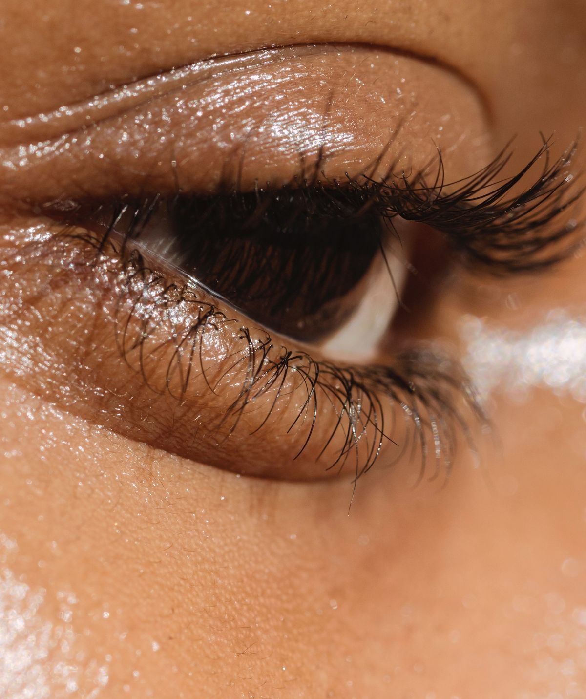 Which Bags are Treated by Lower Eyelid (Blepharoplasty) Surgery?